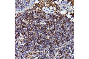 Immunohistochemistry of paraffin-embedded Human anaplastic large cell lymphoma using Human IgM Rabbit mAb (ABIN7267845) at dilution of 1:100 (40x lens). (IGHM Antikörper)