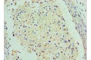 Immunohistochemistry of paraffin-embedded human cervical cancer using ABIN7155341 at dilution of 1:100 (SAP18 Antikörper  (AA 2-153))