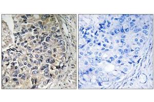 Immunohistochemistry analysis of paraffin-embedded human prostate carcinoma tissue using CMC1 antibody. (SLC25A12 Antikörper  (Internal Region))