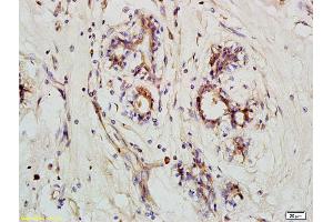 Formalin-fixed and paraffin embedded human breast carcinoma labeled with Anti-NLRX1 Polyclonal Antibody, Unconjugated (ABIN1385925) at 1:200 followed by conjugation to the secondary antibody and DAB staining (NLRX1 Antikörper  (AA 111-210))