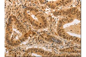 The image on the left is immunohistochemistry of paraffin-embedded Human colon cancer tissue using ABIN7189699(ADRA1B Antibody) at dilution 1/20, on the right is treated with synthetic peptide. (ADRA1B Antikörper)