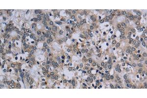 Immunohistochemistry of paraffin-embedded Human liver cancer tissue using TP53AIP1 Polyclonal Antibody at dilution 1:50 (TP53AIP1 Antikörper)