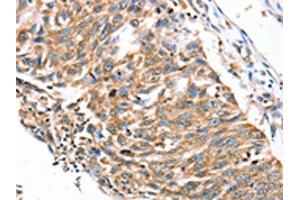 The image on the left is immunohistochemistry of paraffin-embedded Human lung cancer tissue using ABIN7192291(SDC3 Antibody) at dilution 1/30, on the right is treated with synthetic peptide. (SDC3 Antikörper)