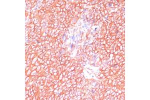 Immunohistochemistry of paraffin-embedded human oophoroma using MOB4 antibody (ABIN6132926, ABIN6143935, ABIN6143936 and ABIN6220703) at dilution of 1:100 (40x lens).