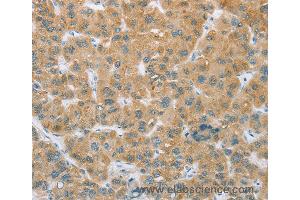 Immunohistochemistry of Human liver cancer using CYP2C9 Polyclonal Antibody at dilution of 1:35 (CYP2C9 Antikörper)