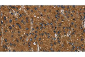 Immunohistochemistry of paraffin-embedded Human liver cancer tissue using MIER2 Polyclonal Antibody at dilution 1:60