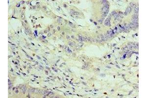 Immunohistochemistry of paraffin-embedded human colon cancer using ABIN7176056 at dilution of 1:100 (ZEB2 Antikörper  (AA 1050-1214))