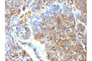 Formalin-fixed, paraffin-embedded human Melanoma stained with Moesin Mouse Monoclonal Antibody (MSN/493). (Moesin Antikörper)