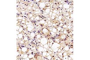 Immunohistochemistry analysis of paraffin embedded human liver cancer using MTHFD1 (ABIN7074609) at dilution of 1: 700 (MTHFD1 Antikörper)