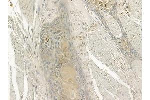 ABIN6256964 and ABIN6274464 at 1/100 staining human esophageal carcinoma by IHC-P.