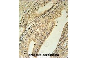 TME Antibody (N-term) (ABIN651651 and ABIN2840344) immunohistochemistry analysis in formalin fixed and paraffin embedded human prostate carcinoma followed by peroxidase conjugation of the secondary antibody and DAB staining. (TMEM134 Antikörper  (N-Term))
