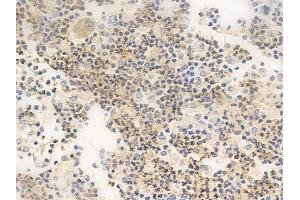 ABIN6265584 and ABIN6266662 at 1/100 staining human colon carcinoma by IHC-P. (TIMP4 Antikörper  (C-Term))