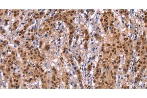 Immunohistochemistry of paraffin-embedded Human gastric cancer tissue using Ephrin A5 Polyclonal Antibody at dilution 1:40 (Ephrin A5 Antikörper)