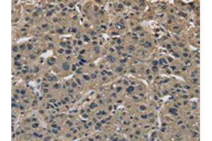 The image on the left is immunohistochemistry of paraffin-embedded Human liver cancer tissue using ABIN7191092(IMPAD1 Antibody) at dilution 1/20, on the right is treated with synthetic peptide. (IMPAD1 Antikörper)
