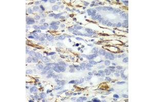 Immunohistochemistry of paraffin-embedded human gastric cancer using CALD1 antibody. (Caldesmon Antikörper  (AA 1-240))