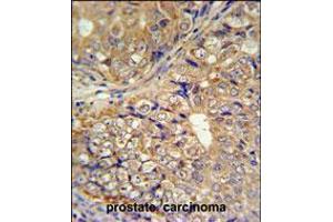 KLHL9 Antibody IHC analysis in formalin fixed and paraffin embedded human prostate carcinoma followed by peroxidase conjugation of the secondary antibody and DAB staining. (KLHL9 Antikörper  (AA 299-326))