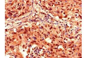 IHC image of ABIN7142208 diluted at 1:1000 and staining in paraffin-embedded human lung cancer performed on a Leica BondTM system.