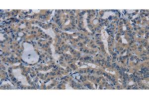 Immunohistochemistry of paraffin-embedded Human thyroid cancer tissue using PIK3CB Polyclonal Antibody at dilution 1:50 (PIK3CB Antikörper)