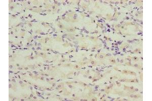 Immunohistochemistry of paraffin-embedded human gastric cancer using ABIN7173269 at dilution of 1:100 (TMEM71 Antikörper  (AA 1-210))