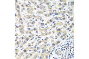 Immunohistochemistry of paraffin-embedded human liver cancer using IL2 antibody at dilution of 1:100 (40x lens). (IL-2 Antikörper)