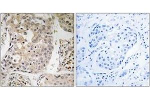 Immunohistochemistry analysis of paraffin-embedded human breast carcinoma tissue, using MRPL41 Antibody.
