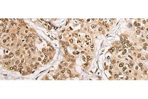 Immunohistochemistry of paraffin-embedded Human prost at e cancer tissue using PHF21A Polyclonal Antibody at dilution of 1:50(x200) (PHF21A Antikörper)