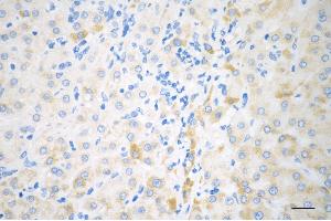 Immunohistochemistry was performed on paraffin-embedded human hepatocarcinoma using BCKDK antibody (ABIN7797783), 1:200). (BCKDK Antikörper)