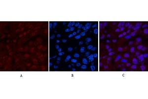 Immunofluorescence analysis of human liver cancer tissue. (XRCC4 Antikörper)