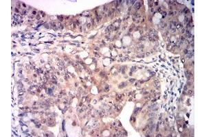 Immunohistochemical analysis of paraffin-embedded rectum cancer tissues using RRM1 mouse mAb with DAB staining. (RRM1 Antikörper  (AA 541-792))