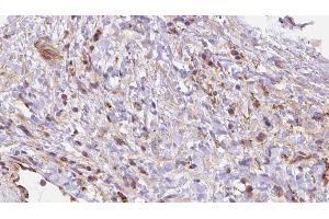 ABIN6272698 at 1/100 staining Human liver cancer tissue by IHC-P.