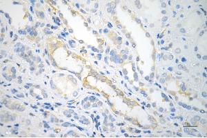 Immunohistochemistry was performed on paraffin-embedded human renal carcinoma using MYH9 antibody (ABIN7799519), 1:).