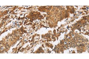 Immunohistochemistry of paraffin-embedded Human gasrtic cancer tissue using CALU Polyclonal Antibody at dilution 1:40 (CALU Antikörper)