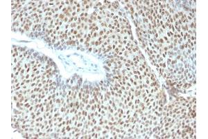 Formalin-fixed, paraffin-embedded human Cervical Tumor stained with Phospho c-Jun Mouse Monoclonal Antibody (C-J 4C4/1). (C-JUN Antikörper)