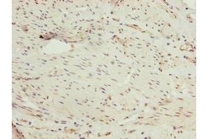Immunohistochemistry of paraffin-embedded human bladder cancer using ABIN7162864 at dilution of 1:100 (PPIL4 Antikörper  (AA 1-492))