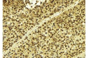 ABIN6275312 at 1/100 staining Human breast cancer tissue by IHC-P. (SP100 Antikörper  (Internal Region))