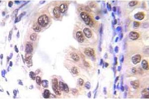 Immunohistochemistry (IHC) analyzes of p-STAT1 antibody in paraffin-embedded human lung carcinoma tissue. (STAT1 Antikörper  (pSer727))