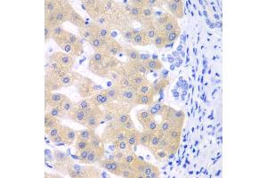 Immunohistochemistry of paraffin-embedded human liver cancer using CYP2C18 antibody.