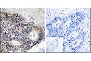 Immunohistochemistry analysis of paraffin-embedded human colon carcinoma, using ABHD12B Antibody.