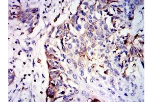 Immunohistochemical analysis of paraffin-embedded esophageal cancer tissues using GSTM1 mouse mAb with DAB staining. (GSTM1 Antikörper)