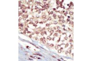 Formalin-fixed and paraffin-embedded human cancer tissue reacted with the primary antibody, which was peroxidase-conjugated to the secondary antibody, followed by AEC staining. (EPH Receptor A5 Antikörper  (C-Term))