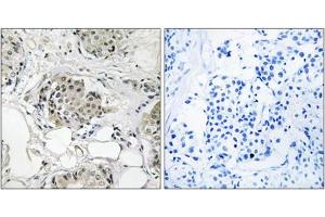 Immunohistochemistry analysis of paraffin-embedded human breast carcinoma tissue, using USP13 antibody. (USP13 Antikörper  (C-Term))