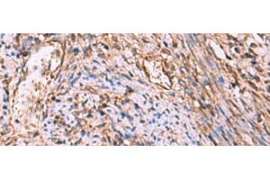 Immunohistochemistry of paraffin-embedded Human cervical cancer tissue using RHAG Polyclonal Antibody at dilution of 1:130(x200) (RHAG Antikörper)