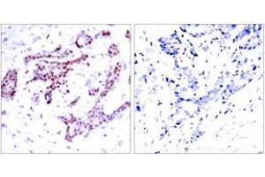 Immunohistochemistry analysis of paraffin-embedded human breast carcinoma, using STAT1 (Phospho-Tyr701) Antibody. (STAT1 Antikörper  (pTyr701))