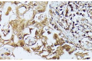 Immunohistochemistry of paraffin-embedded Human lung cancer using DAPK3 Polyclonal Antibody at dilution of 1:100 (40x lens). (DAPK3 Antikörper)