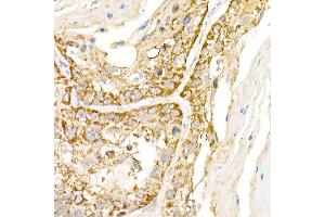 Immunohistochemistry of paraffin-embedded human lung cancer using B1 Rabbit pAb (ABIN6129916, ABIN6136962, ABIN6136963 and ABIN6222795) at dilution of 1:150 (40x lens). (AP3B1 Antikörper  (AA 895-1094))