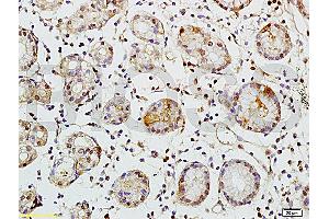 Formalin-fixed and paraffin embedded human colon carcinoma tissue labeled with Rabbit Anti-TEM1/CD248 Polyclonal Antibody (ABIN677573) at 1:200 followed by conjugation to the secondary antibody and DAB staining.