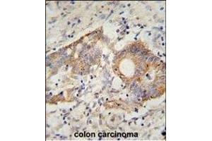 Immunohistochemistry (Paraffin-embedded Sections) (IHC (p)) image for anti-HERV-H LTR-Associating 2 (HHLA2) (AA 58-87) antibody (ABIN654607)