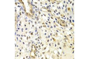 Immunohistochemistry of paraffin-embedded human uterine cancer using RAD50 Antibody. (RAD50 Antikörper)