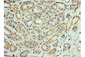 Immunohistochemistry of paraffin-embedded human breast cancer using ABIN7150549 at dilution of 1:100 (DNAJC2 Antikörper  (AA 1-140))
