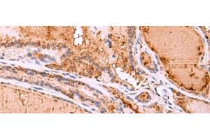 Immunohistochemistry of paraffin-embedded Human thyroid cancer tissue using HTRA4 Polyclonal Antibody at dilution of 1:35(x200) (HTRA4 Antikörper)